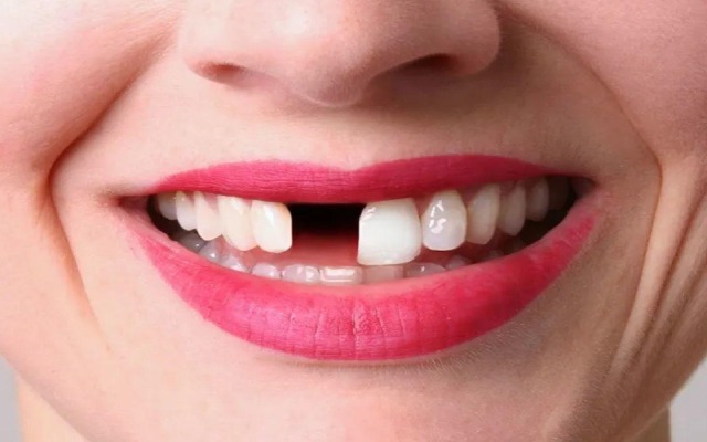 Mơ thấy rụng răng nhưng không chảy máu